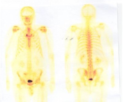 Skeletal scintigraphy